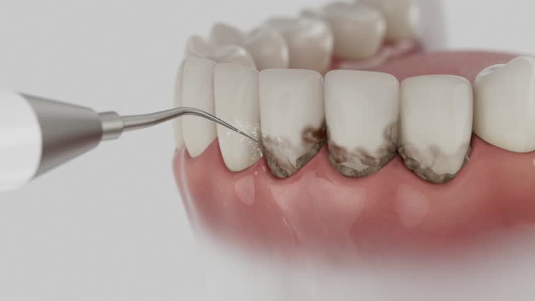 Trusted Wisdom Tooth Removal service in Zebulon, GA - Dentist Open Now
